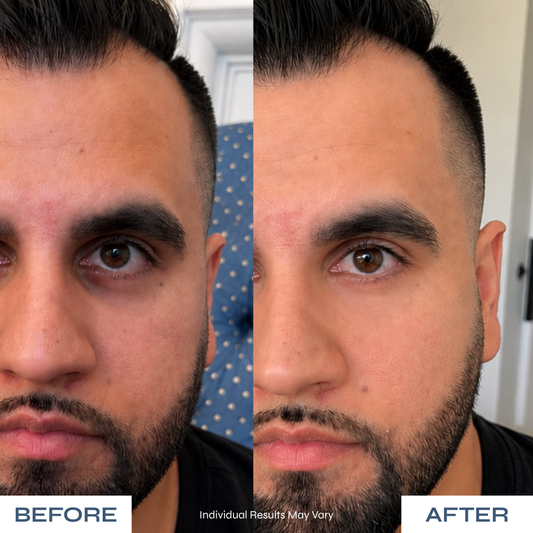 Microneedle Under-Eye Patches - Visibly Lighter Dark Circles