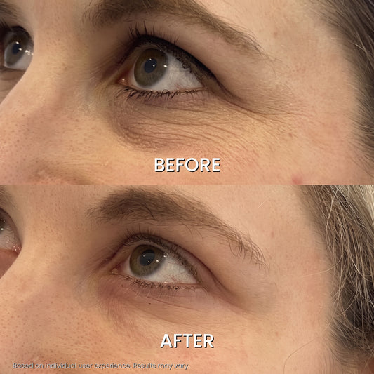 Microneedle Eye Patches - Wake Up Less Puffy