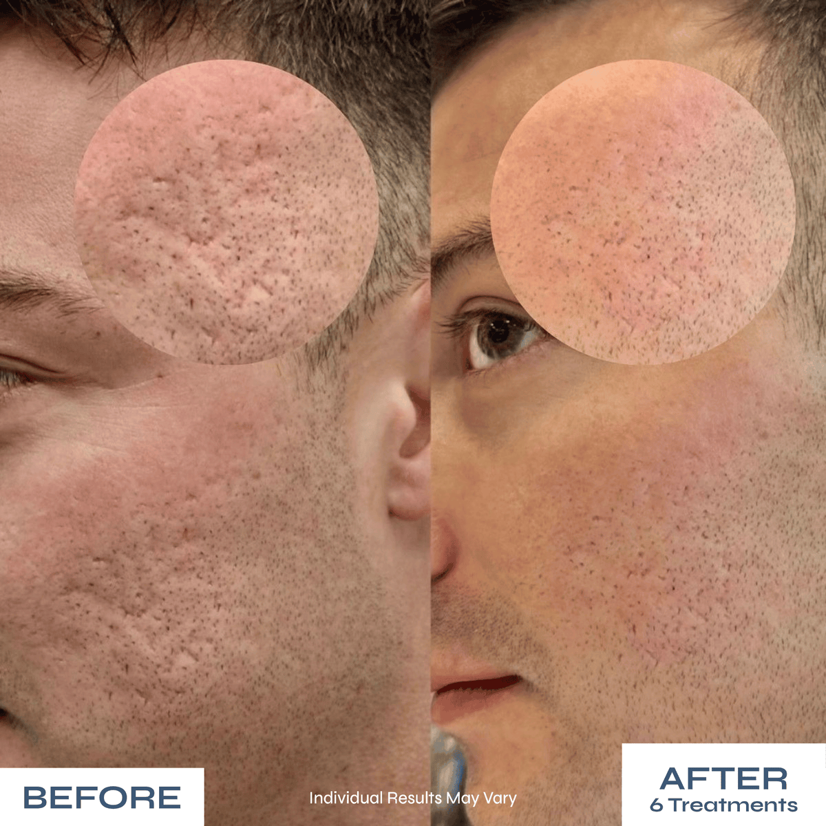 Microneedle PDRN Kit - Fades Post-Acne Scars