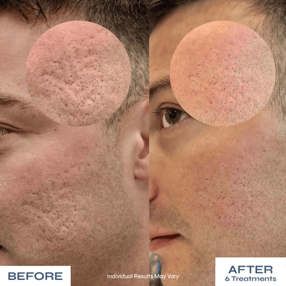 Microneedle PDRN Kit - Fades Post-Acne Scars