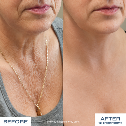 Microneedle Anti-Aging Kit - Softer Neck Lines, Firmer-Looking Skin