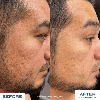 Microneedle PDRN Kit - Fades Post-Acne Scars