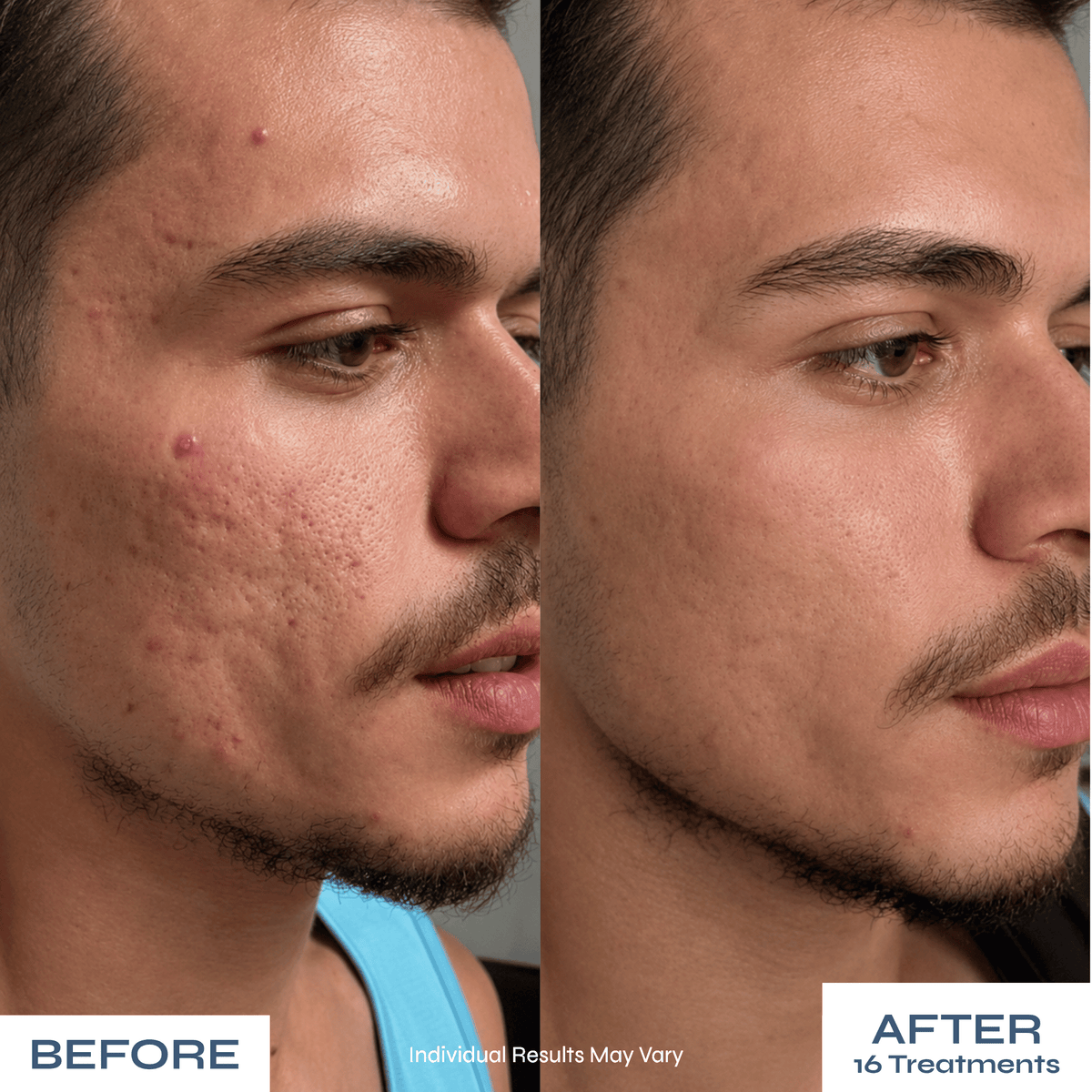 Microneedle PDRN Kit - Fades Post-Acne Scars