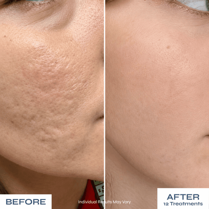 Microneedle PDRN Kit - Fades Post-Acne Scars