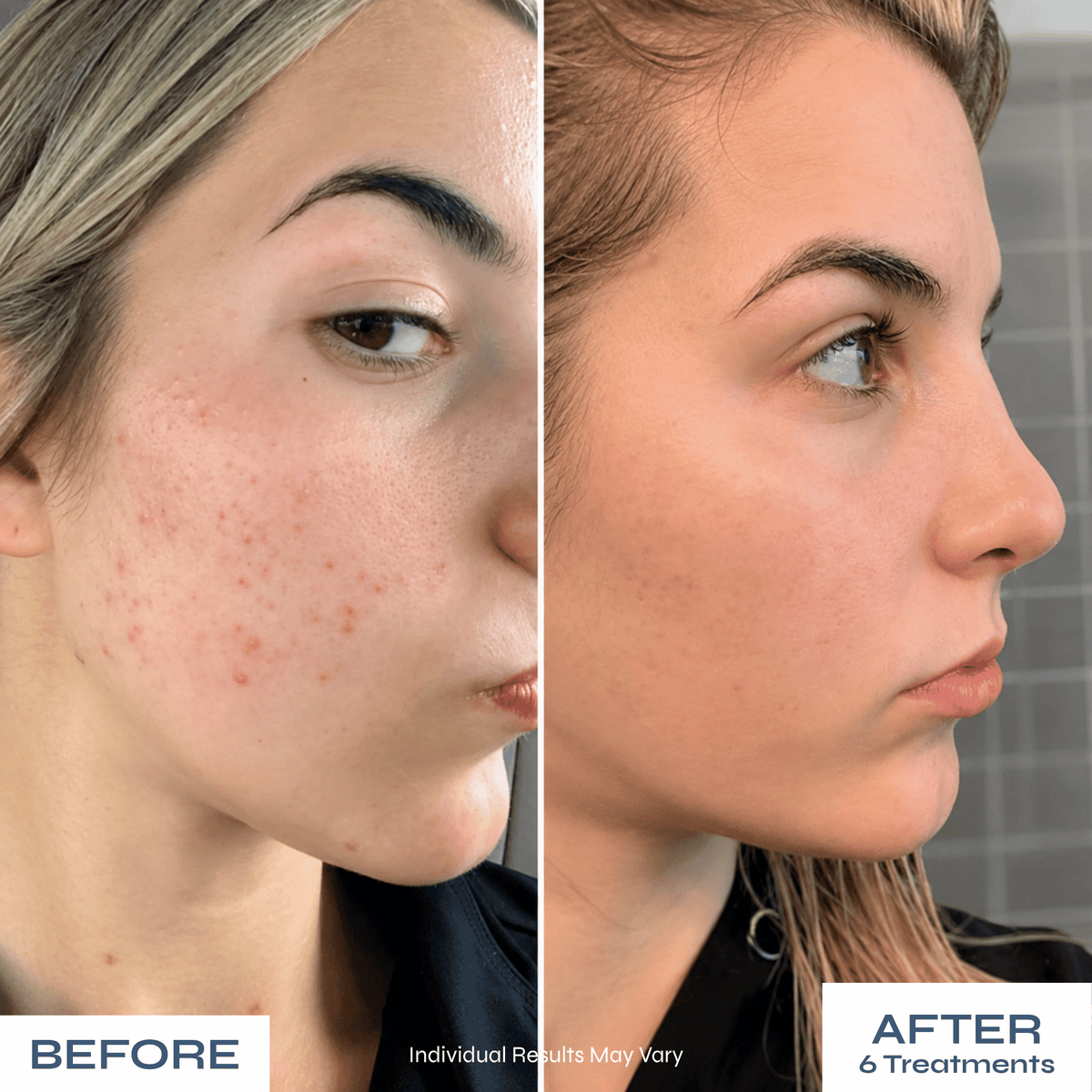 Microneedle PDRN Kit - Fades Post-Acne Scars