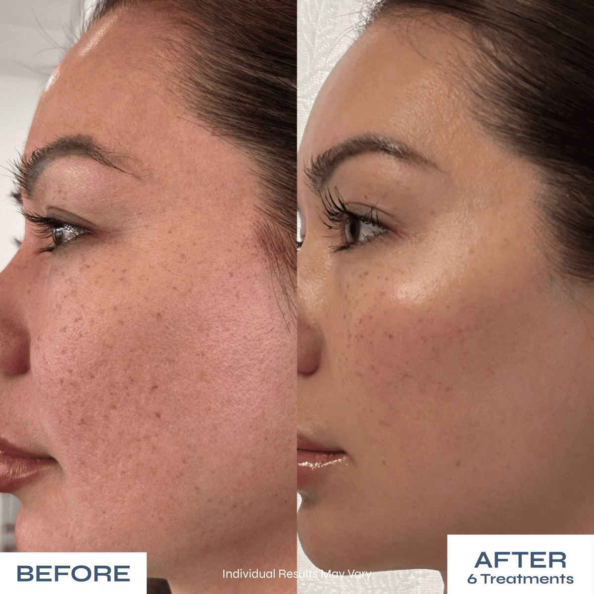 Microneedle PDRN Kit - Fades Post-Acne Scars