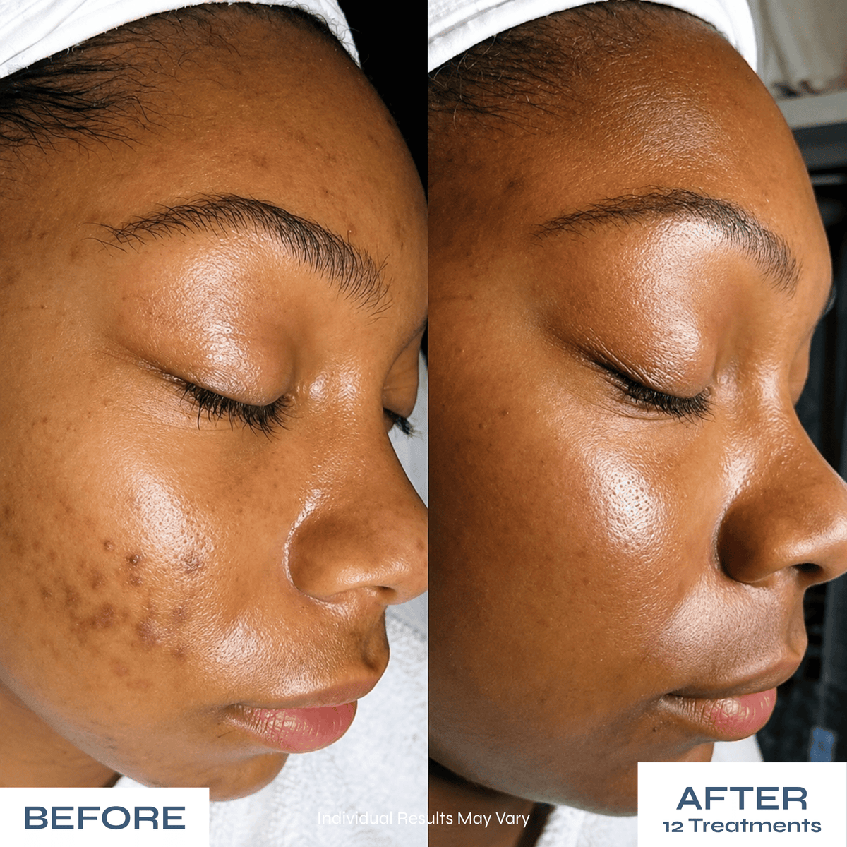 Microneedle PDRN Kit - Fades Post-Acne Scars