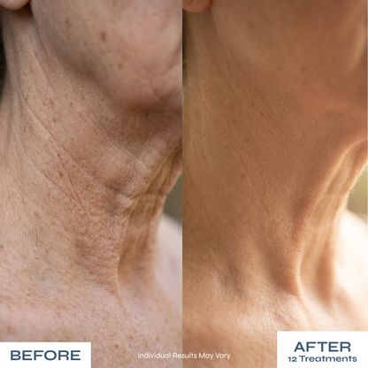 Microneedle Anti-Aging Kit - Softer Neck Lines, Firmer-Looking Skin