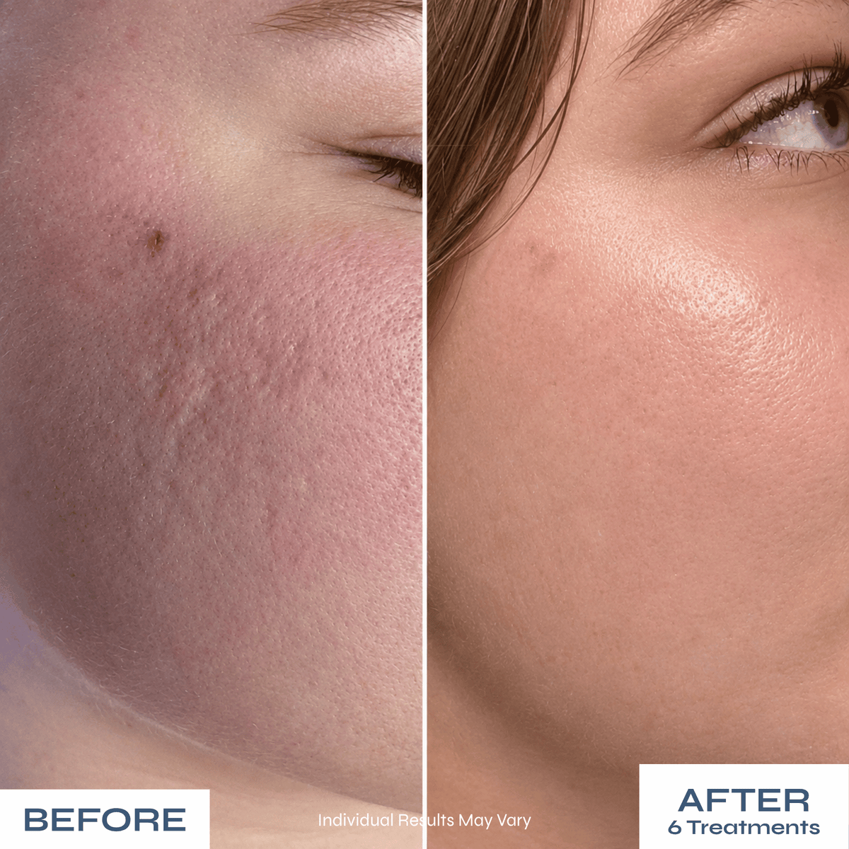 Microneedle PDRN Kit - Fades Post-Acne Scars