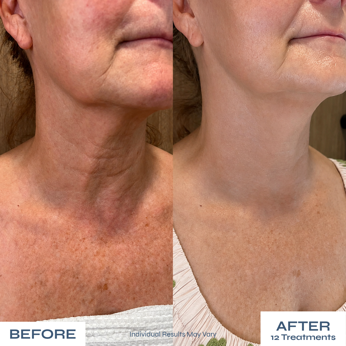 Microneedle Anti-Aging Kit - Softer Neck Lines, Firmer-Looking Skin