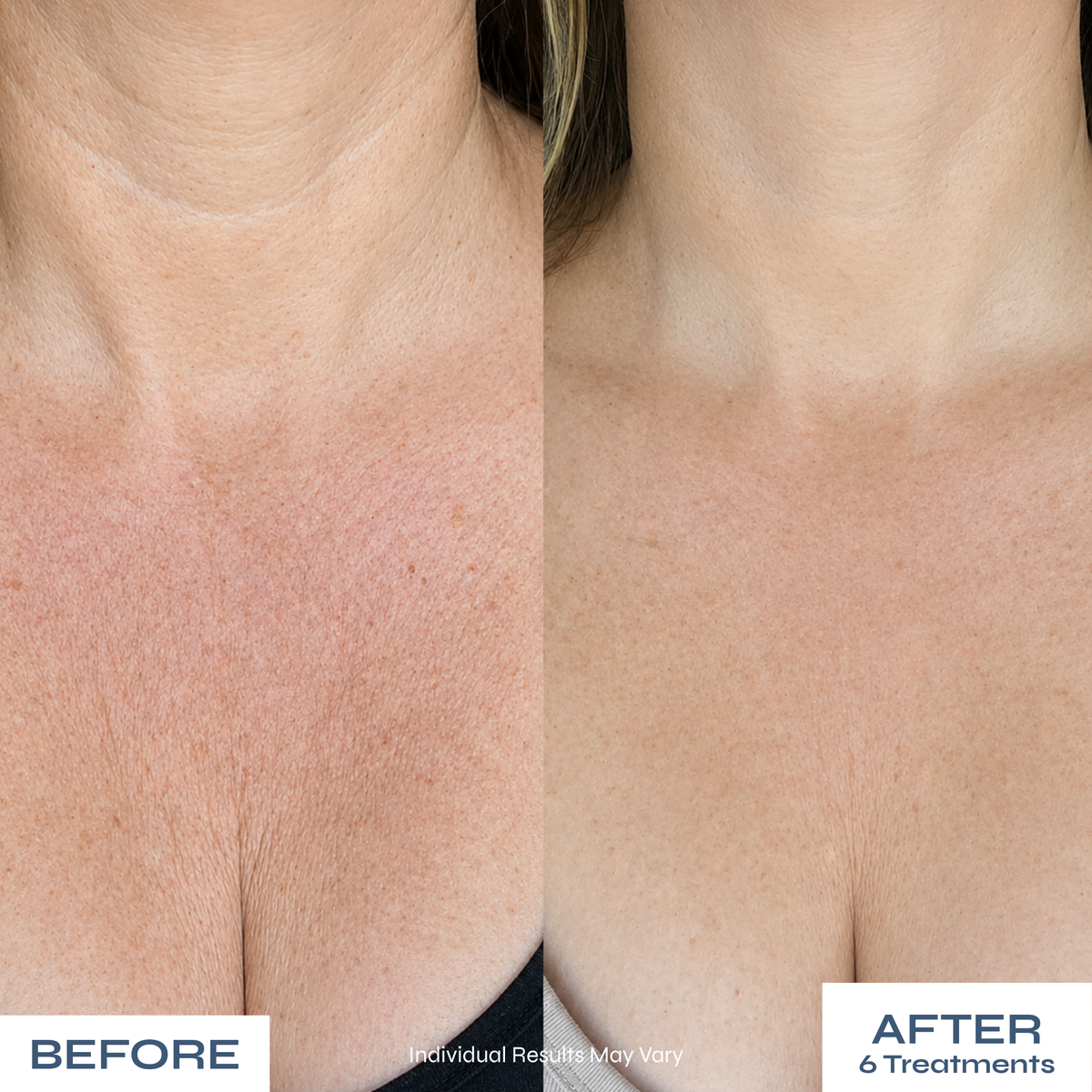 Microneedle Anti-Aging Kit - Softer Neck Lines, Firmer-Looking Skin