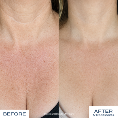 Microneedle Anti-Aging Kit - Softer Neck Lines, Firmer-Looking Skin