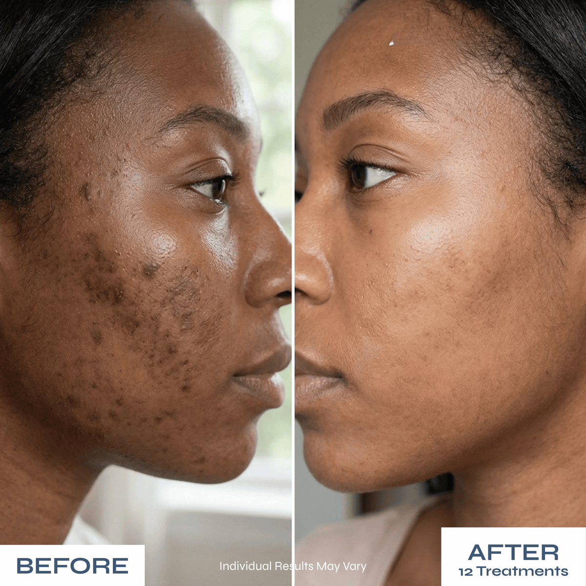 Microneedle PDRN Kit - Fades Post-Acne Scars