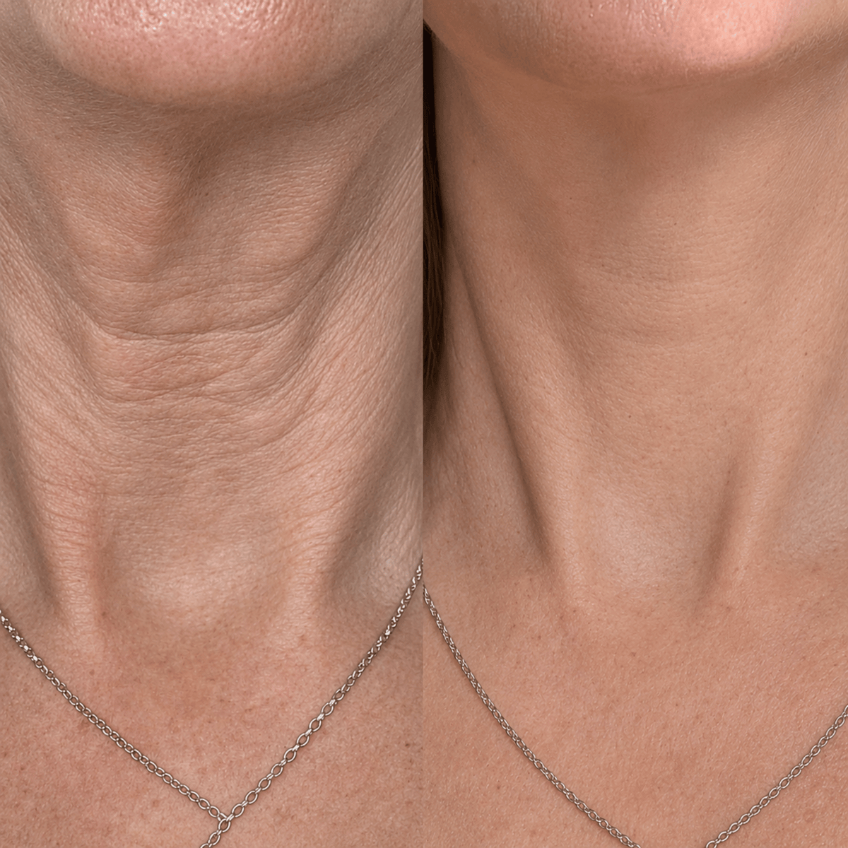 My deepest neck lines look so much softer