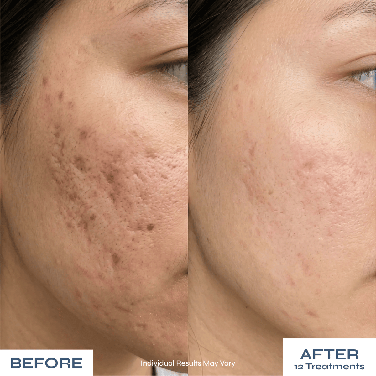Microneedle PDRN Kit - Fades Post-Acne Scars