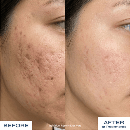 Microneedle PDRN Kit - Fades Post-Acne Scars