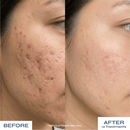 Microneedle PDRN Kit - Fades Post-Acne Scars