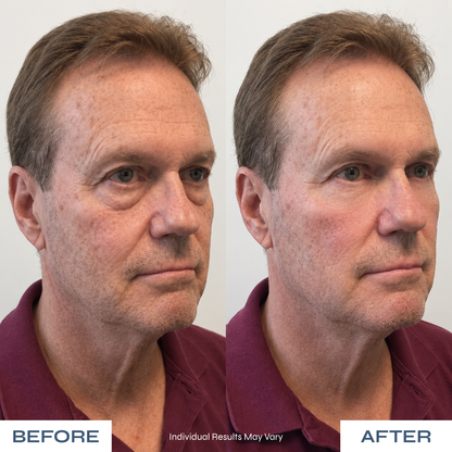 Microneedle Under-Eye Patches - Visibly Lighter Dark Circles