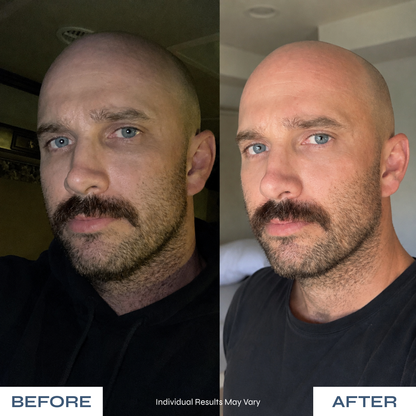 Microneedle Under-Eye Patches - Visibly Lighter Dark Circles