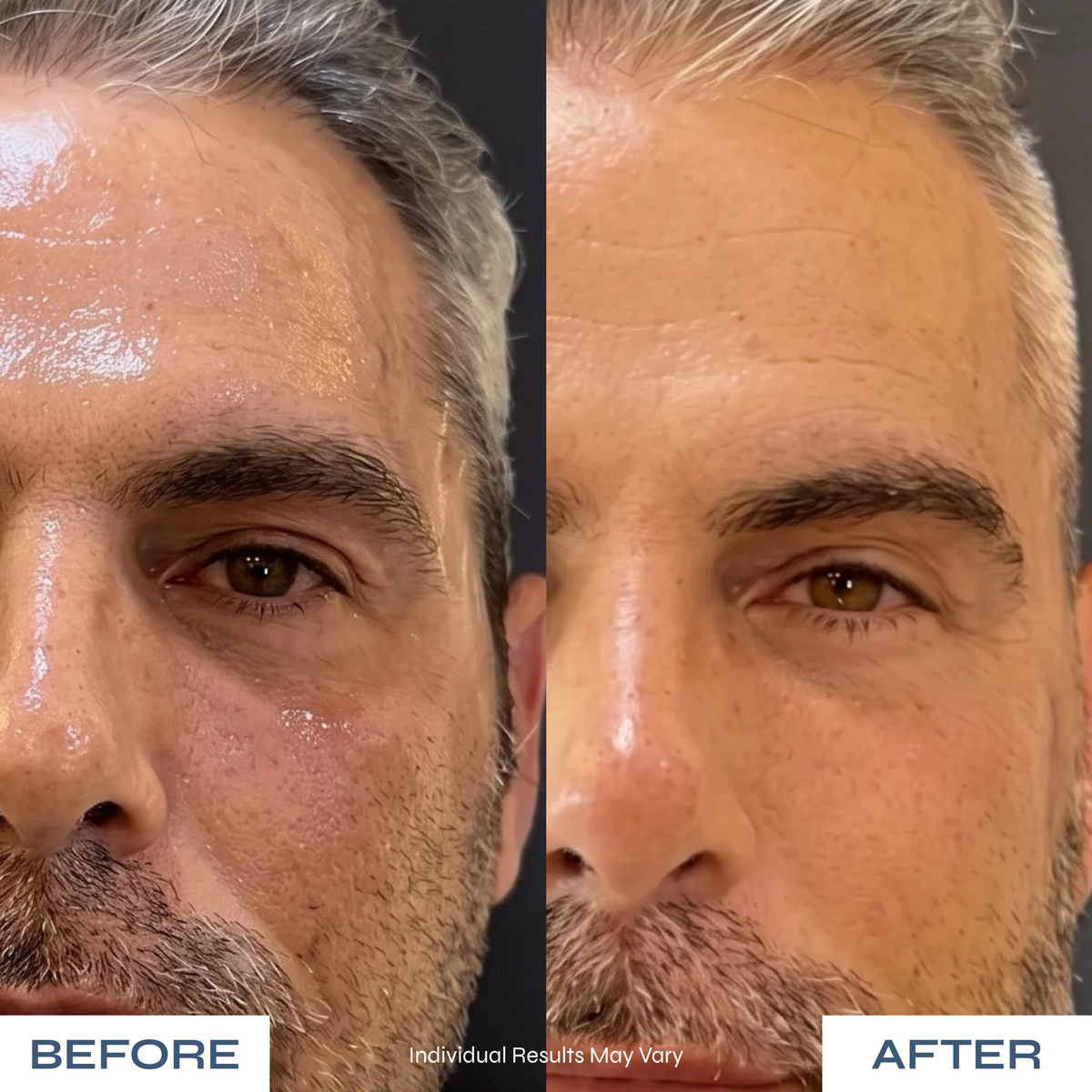 Microneedle Under-Eye Patches - Visibly Lighter Dark Circles