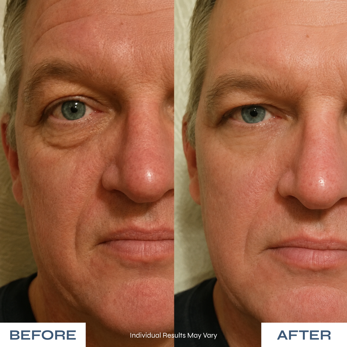Microneedle Under-Eye Patches - Visibly Lighter Dark Circles
