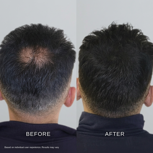 Microneedle Scalp Kit - For Thicker-Looking Hair