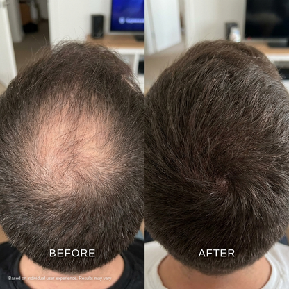 Before and after: less scalp showing through at the crown after using the Ma Repose Microneedle Scalp Kit
