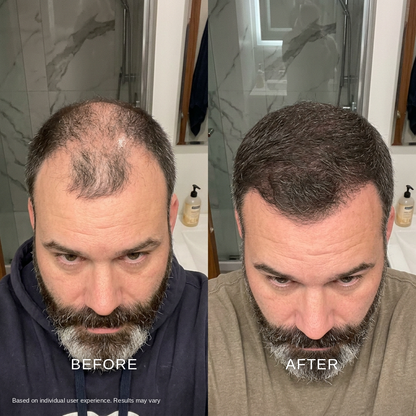 Before and after: denser-looking hairline after using the Ma Repose Microneedle Scalp Kit
