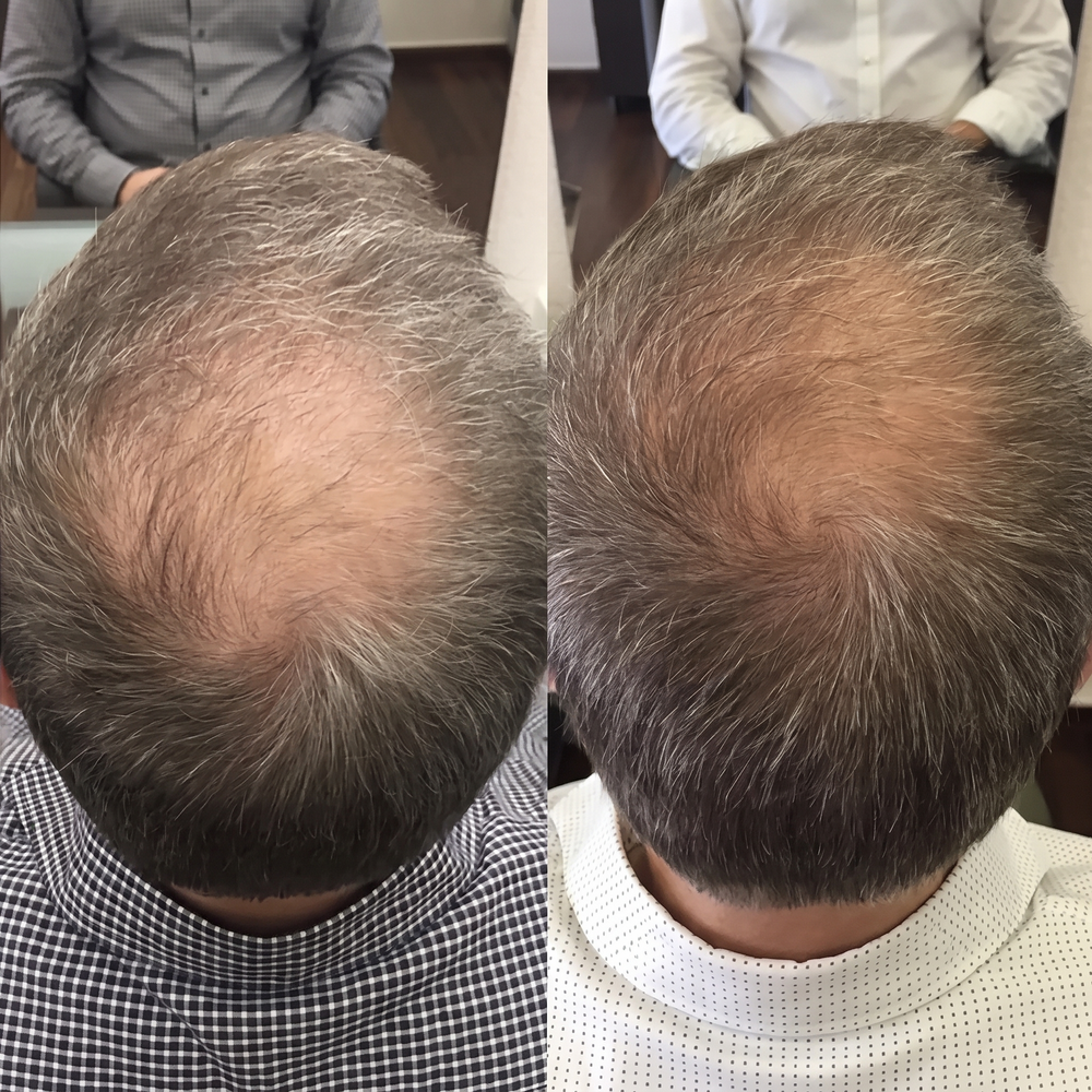 Less scalp showing at the part