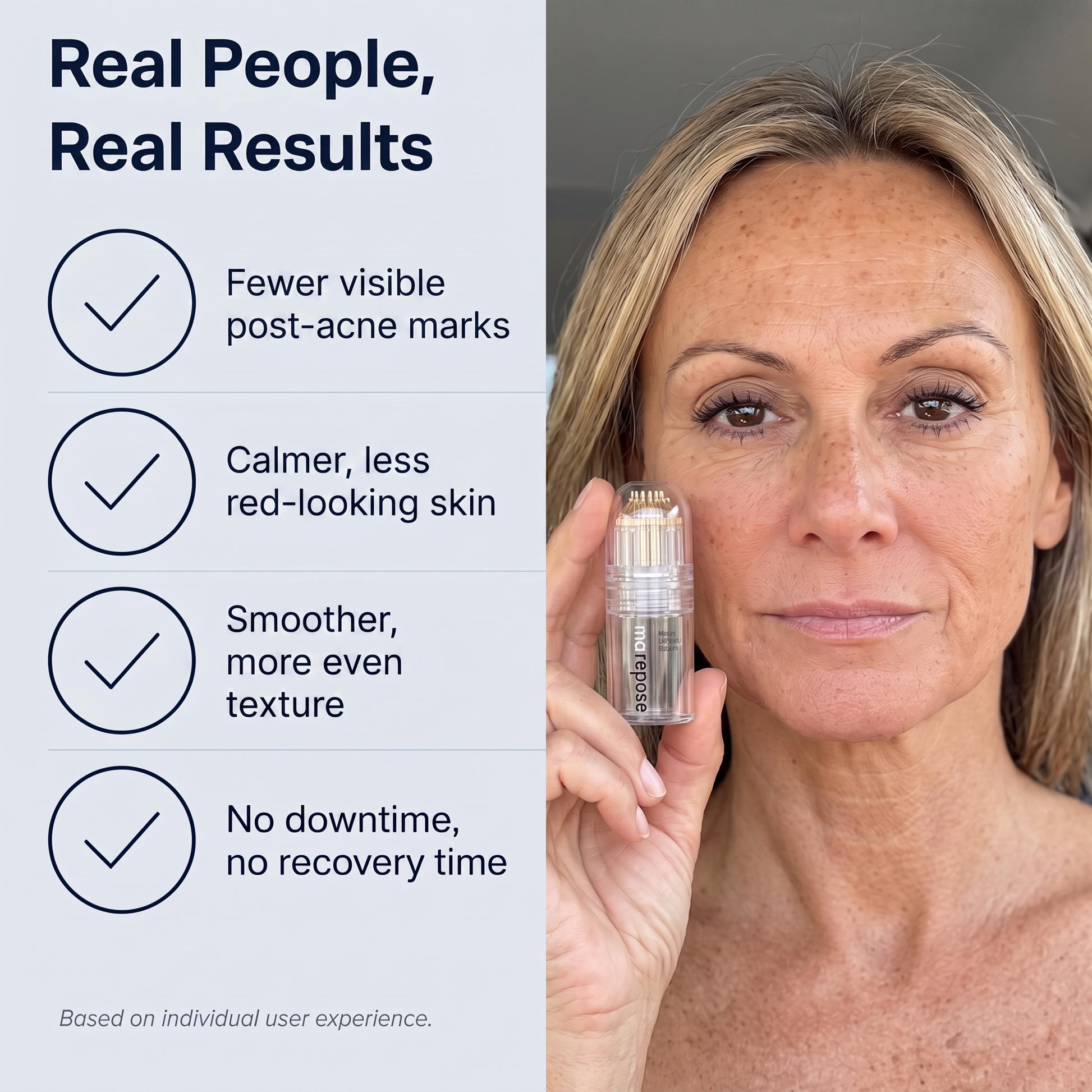 Real people, real results: fewer visible post-acne marks, calmer and less red-looking skin, smoother and more even texture, no downtime and no recovery time. Based on individual user experience.